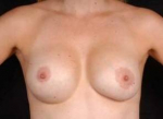 Aesthetic Breast Revision - Case #4 Before