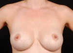 Aesthetic Breast Revision - Case #4 After