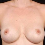 Aesthetic Breast Revision - Case #4 After