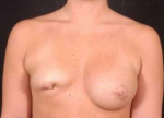 Aesthetic Breast Revision - Case #5 Before