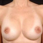 Aesthetic Breast Revision - Case #6 After