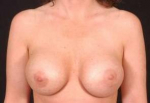 Aesthetic Breast Revision - Case #7 Before