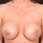 Aesthetic Breast Revision - Case #7 Before