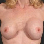 Aesthetic Breast Revision - Case #8 Before