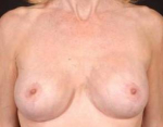 Aesthetic Breast Revision - Case #8 After