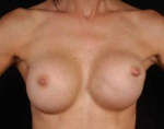 Aesthetic Breast Revision - Case #9 Before