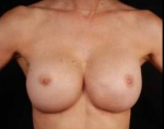 Aesthetic Breast Revision - Case #9 After