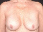 Aesthetic Breast Revision - Case #10 Before