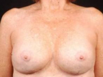 Aesthetic Breast Revision - Case #10 After