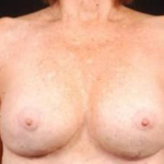 Aesthetic Breast Revision - Case #10 After