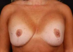 Aesthetic Breast Revision - Case #11 Before