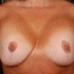 Aesthetic Breast Revision - Case #11 Before