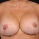 Aesthetic Breast Revision - Case #11 After
