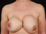 Aesthetic Breast Revision - Case #13 Before