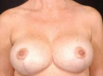 Aesthetic Breast Revision - Case #13 After