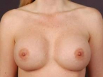 Aesthetic Breast Revision - Case #14 After