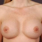 Aesthetic Breast Revision - Case #14 After
