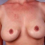 Aesthetic Breast Revision - Case #15 Before