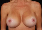Aesthetic Breast Revision - Case #16 After