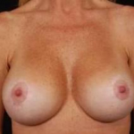 Aesthetic Breast Revision - Case #16 After