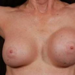 Aesthetic Breast Revision - Case #17 Before