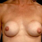 Aesthetic Breast Revision - Case #18 Before