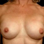 Aesthetic Breast Revision - Case #18 After
