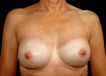 Aesthetic Breast Revision - Case #19 After