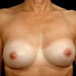 Aesthetic Breast Revision - Case #19 After
