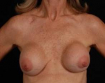 Aesthetic Breast Revision - Case #20 Before