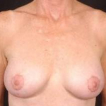 Aesthetic Breast Revision - Case #21 After