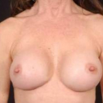 Aesthetic Breast Revision - Case #23 After