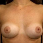 Aesthetic Breast Revision - Case #24 After