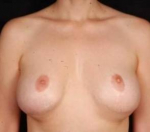 Aesthetic Breast Revision - Case #26 Before