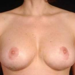 Aesthetic Breast Revision - Case #26 After