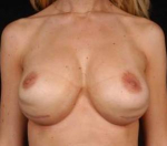 Aesthetic Breast Revision - Case #27 Before