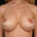 Aesthetic Breast Revision - Case #27 Before