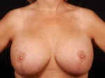 Aesthetic Breast Revision - Case #28 After