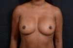 Aesthetic Breast Revision - Case #29 Before