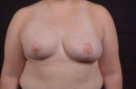 Breast Asymmetry Correction - Case #12 After