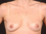 Breast Asymmetry Correction - Case #1 Before