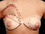 Breast Asymmetry Correction - Case #4 Before