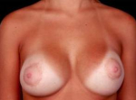 Breast Asymmetry Correction - Case #5 After