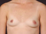Breast Asymmetry Correction - Case #7a Before