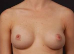 Breast Asymmetry Correction - Case #7a After