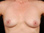 Breast Asymmetry Correction - Case #9 Before