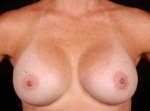 Breast Asymmetry Correction - Case #9 After