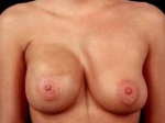 Breast Asymmetry Correction - Case #10 After