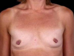 Breast Augmentation 410 - Case #1 Before