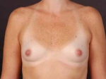 Breast Augmentation 410 - Case #4 Before